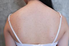 Treatment for Back Acne